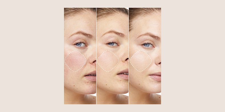 In Article Ruddy Skin Color PrimeLab